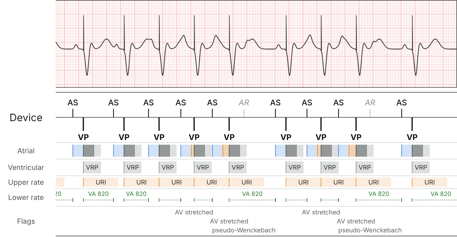 Second half of the DDD example: sinus tachycardia faster than the upper rate. The AV delays stretch (orange) so the ventricle isn't paced faster than 120 bpm, until a P wave falls in PVARP (AR): pseudo-Wenckebach.