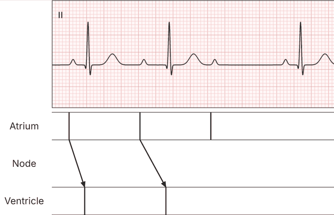 Steps 2–3: the two conducted beats, with the PR interval lengthening.